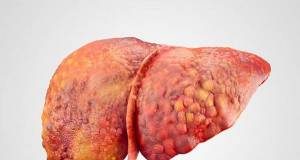 چطور چربی کبد را از بین ببریم؟