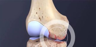 چه کنیم آرتروز نگیریم؟