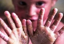 واریز دو میلیارد تومان به حساب هر بیمار پروانهای