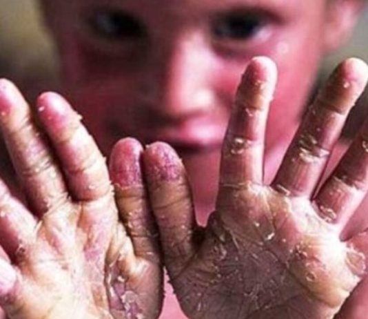 واریز دو میلیارد تومان به حساب هر بیمار پروانهای